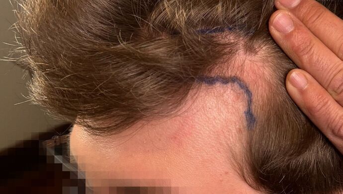 FUE Hair Restoration: Case 46 - Before