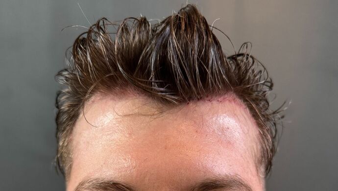 FUE Hair Restoration: Case 46 - Before
