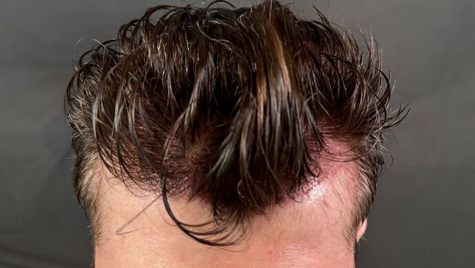 FUE Hair Restoration: Case 46 - Before