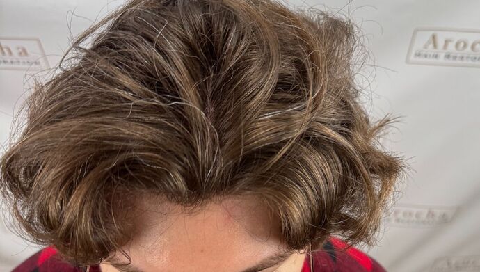 FUE Hair Restoration: Case 46 - After