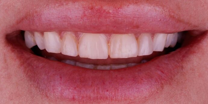 Smile Design Cases Case 14 - Before