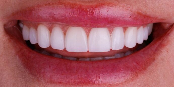 Smile Design Cases Case 14 - After