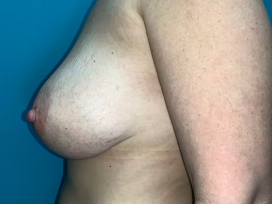 Breast Lift: Case 1 - Before