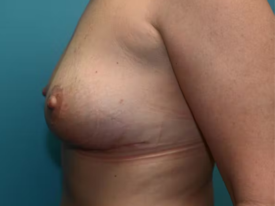 Breast Lift: Case 1 - After