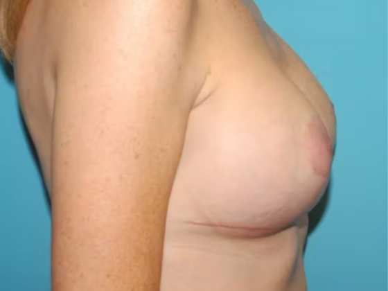 Breast Lift: Case 3 - After