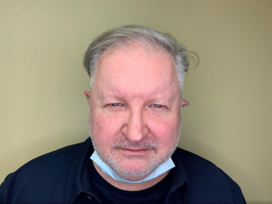 Blepharoplasty: Case 2 - Before