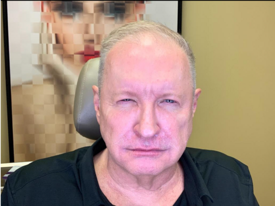 Blepharoplasty: Case 2 - After