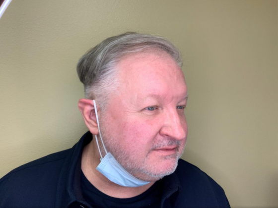 Blepharoplasty: Case 2 - Before