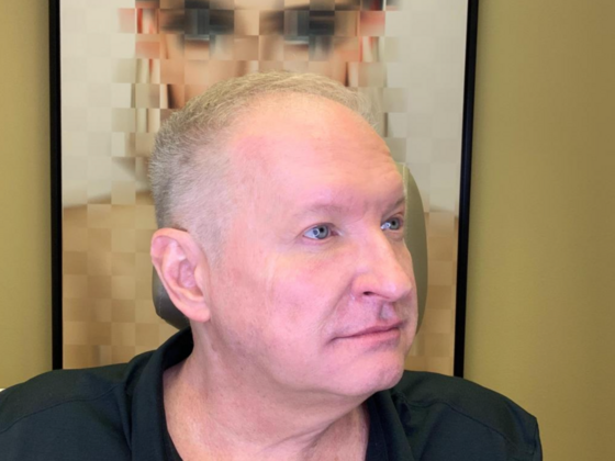 Blepharoplasty: Case 2 - After