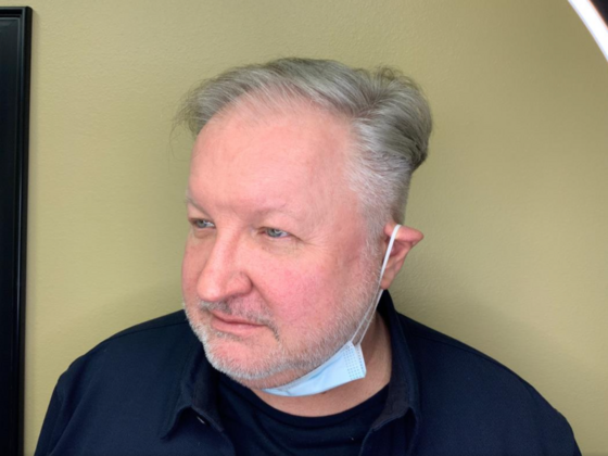 Blepharoplasty: Case 2 - Before