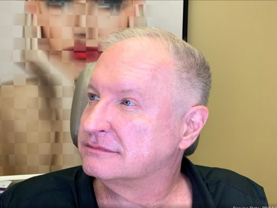 Blepharoplasty: Case 2 - After