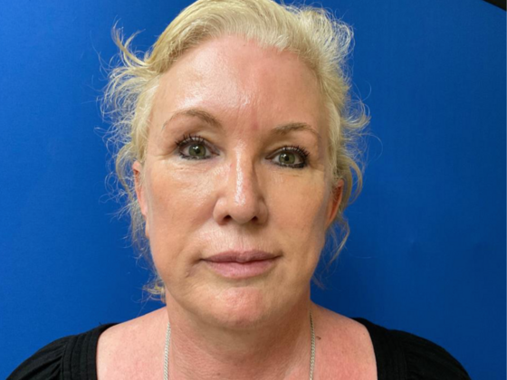 Facelift Case 11 - After