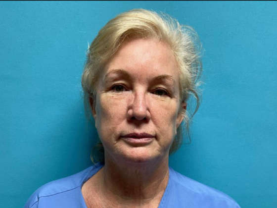 Facelift Case 11 - Before