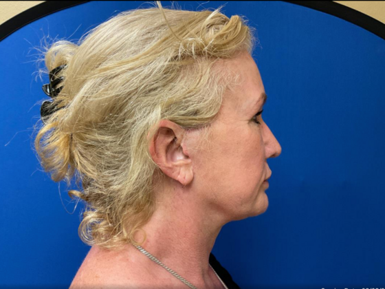 Facelift: Case 11 - After