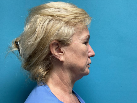 Facelift: Case 11 - Before