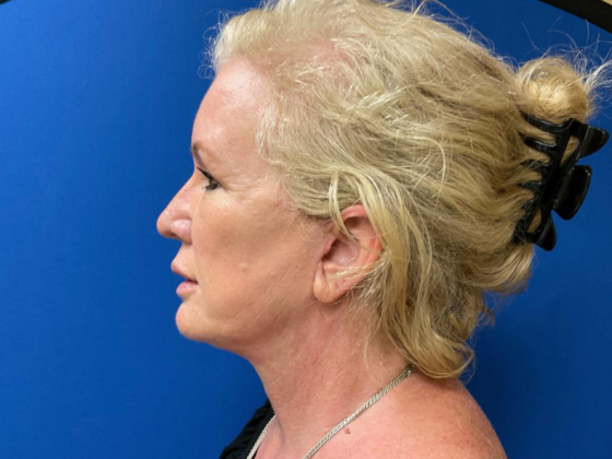 Facelift: Case 11 - After