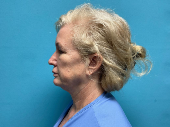 Facelift: Case 11 - Before