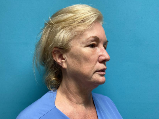 Facelift: Case 11 - Before