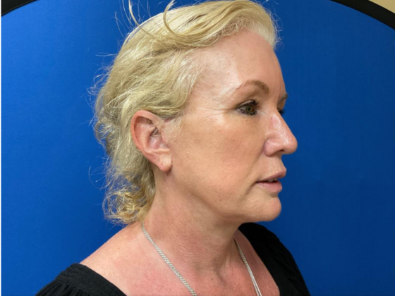 Facelift: Case 11 - After