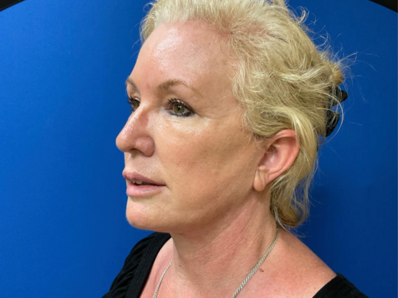 Facelift: Case 11 - After