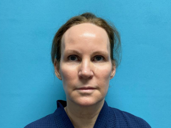 Facelift Case 13 - Before