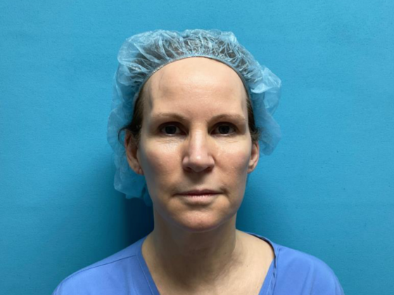 Facelift Case 13 - After