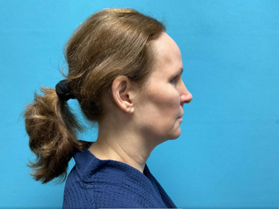 Facelift: Case 13 - Before