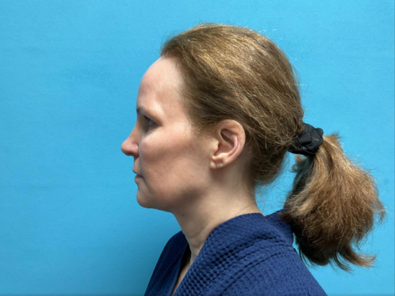 Facelift: Case 13 - Before