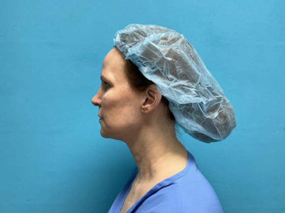 Facelift: Case 13 - After