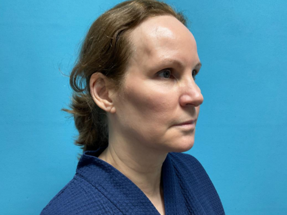 Facelift: Case 13 - Before