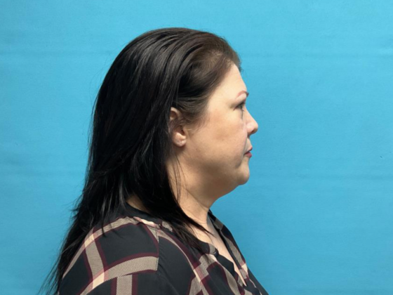 Blepharoplasty: Case 3 - After