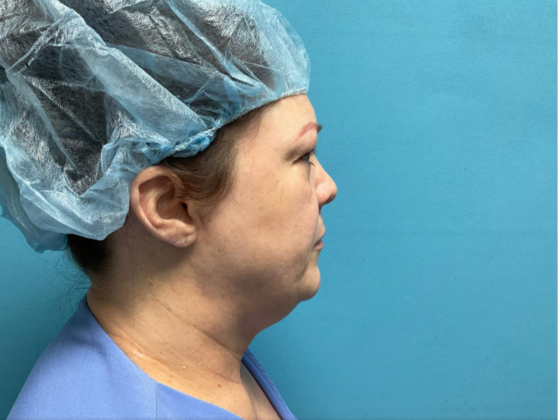 Blepharoplasty: Case 3 - Before