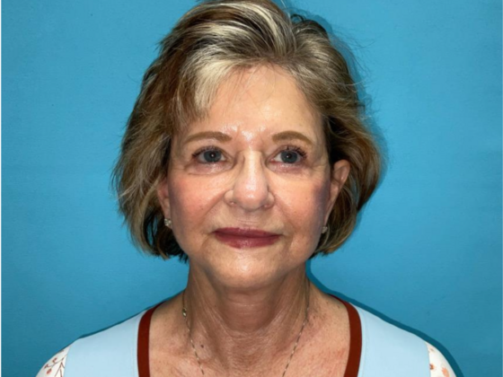 Facelift Case 5 - After