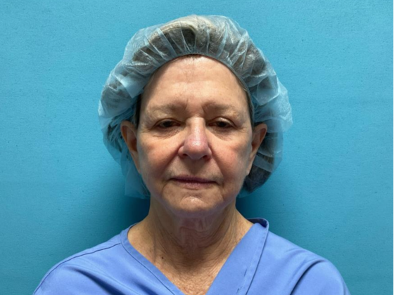 Facelift Case 5 - Before