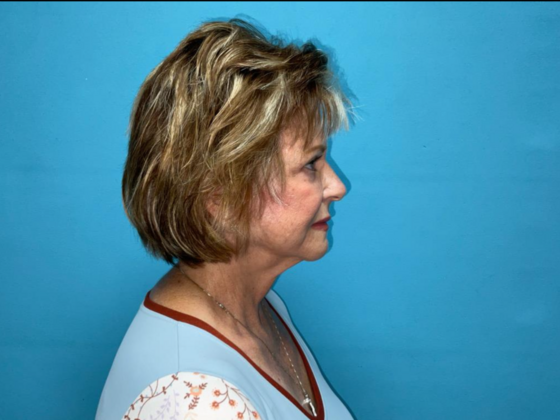 Facelift: Case 5 - After