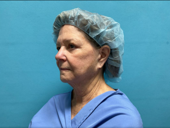 Facelift: Case 5 - Before