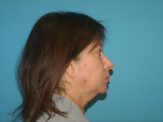 Blepharoplasty: Case 4 - Before