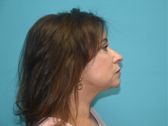 Blepharoplasty: Case 4 - After