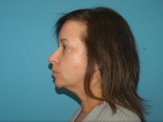 Blepharoplasty: Case 4 - Before