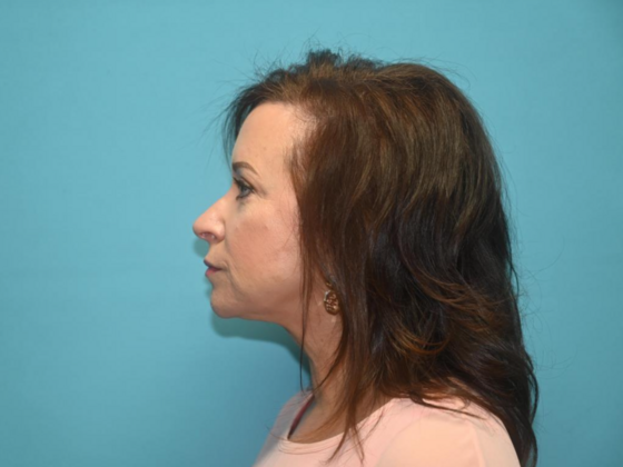 Blepharoplasty: Case 4 - After