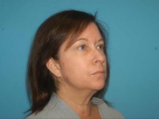 Blepharoplasty: Case 4 - Before