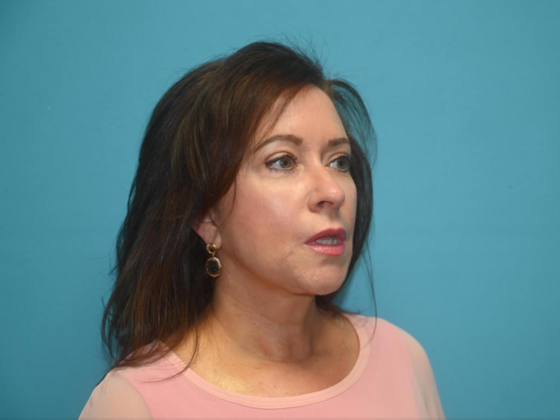 Blepharoplasty: Case 4 - After