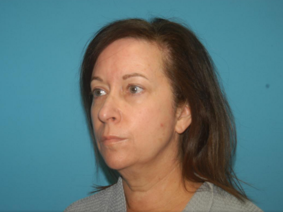 Blepharoplasty: Case 4 - Before