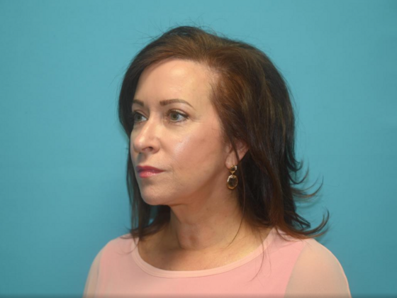 Blepharoplasty: Case 4 - After