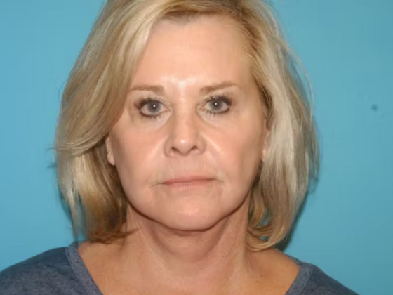 Facelift Case 14 - After