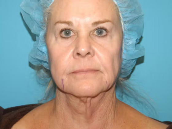Facelift Case 14 - Before