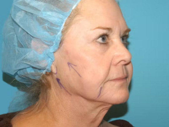 Facelift: Case 14 - Before
