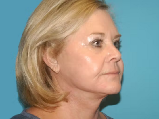 Facelift: Case 14 - After