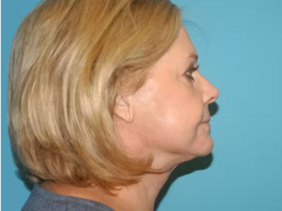 Facelift: Case 14 - After