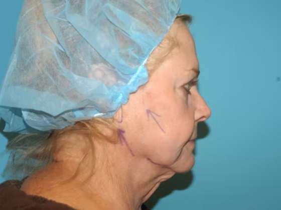 Facelift: Case 14 - Before